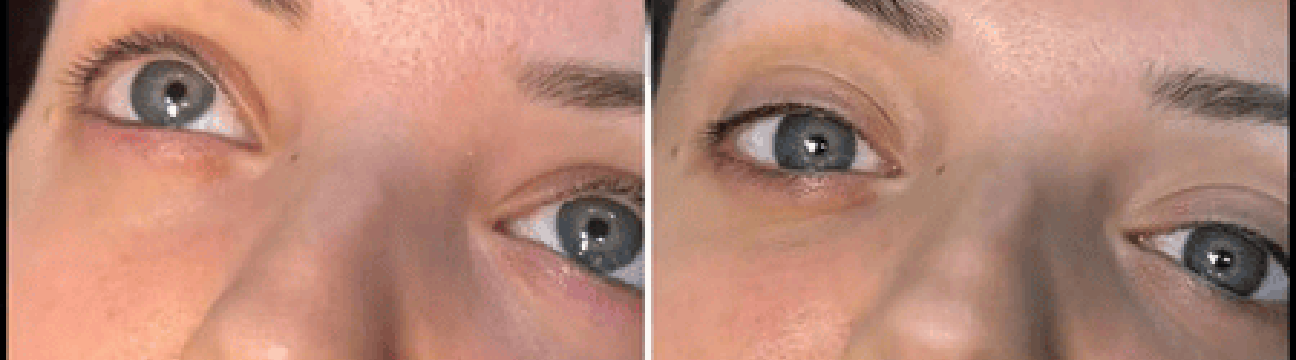 Dermal Fillers